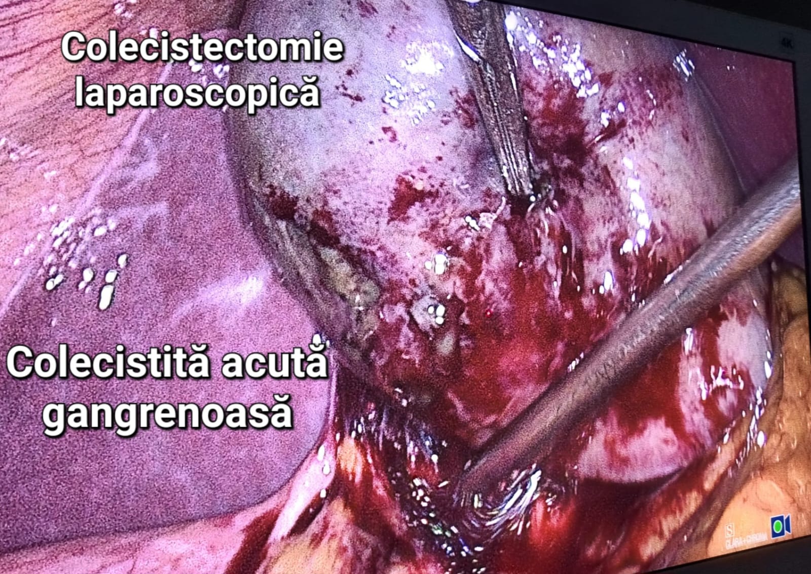 Colecistita acuta gangrenoasa