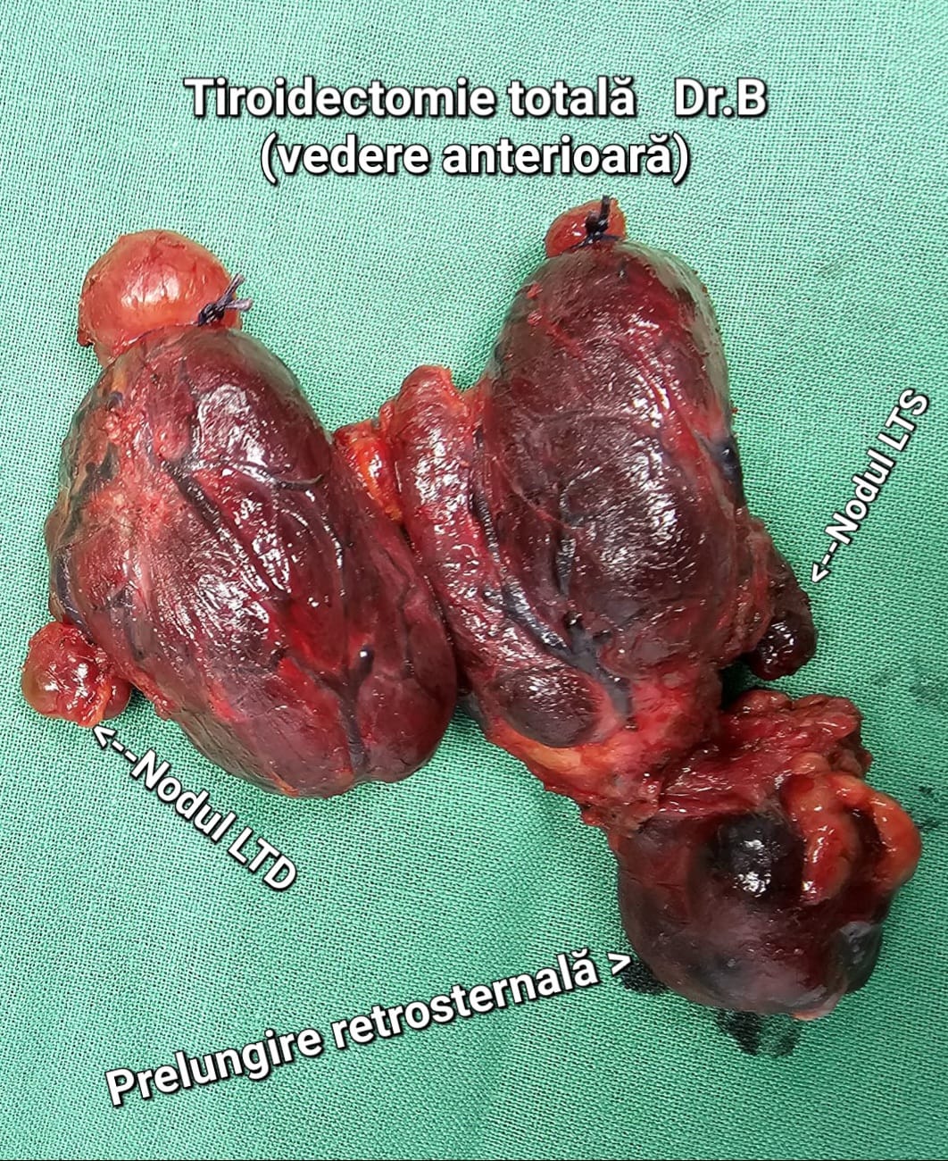 Tiroidectomie toala