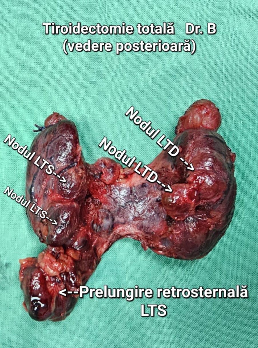 Tiroidectomie toala